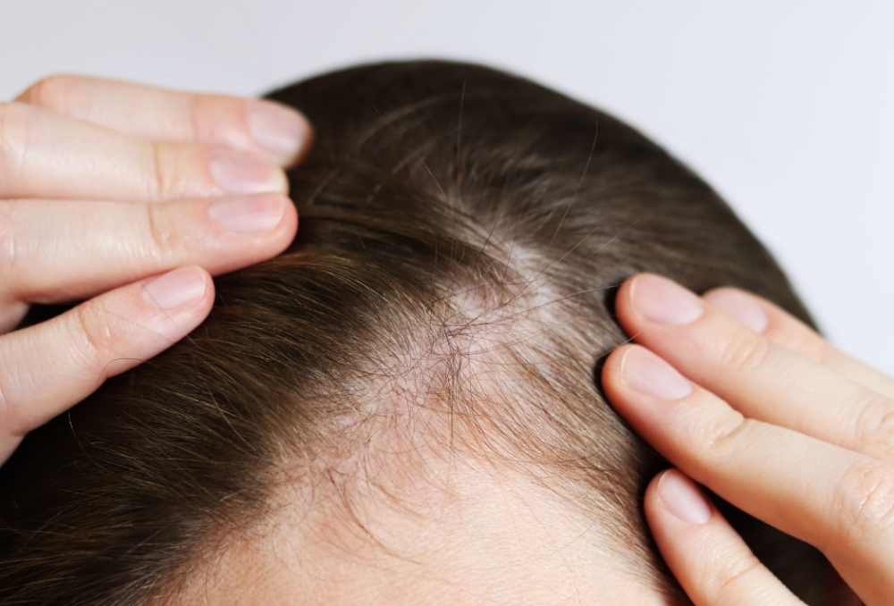 anti-dandruff-herbal-spray