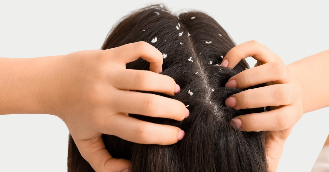 anti-dandruff-herbal-spray