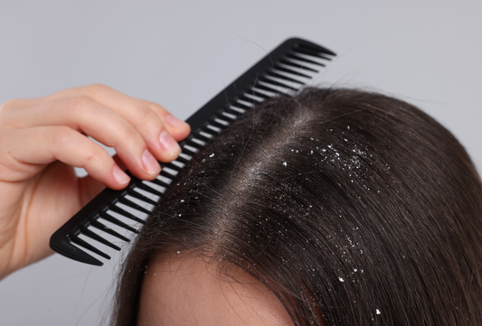 Why Hair Fall Gets Worse When Dandruff Is Ignored